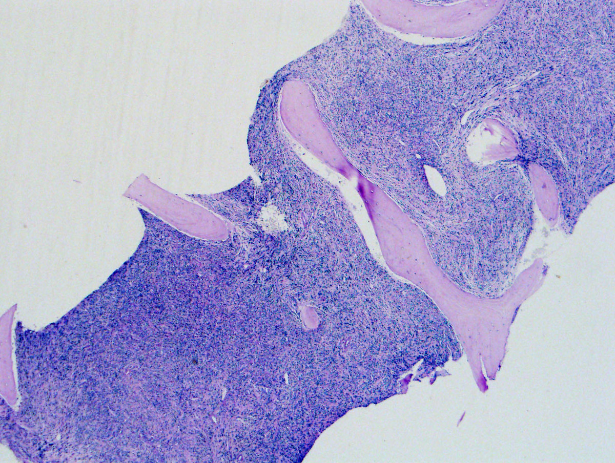 Fig. 1 Biopsy showed fibrotic marrow with 100% cellularity.